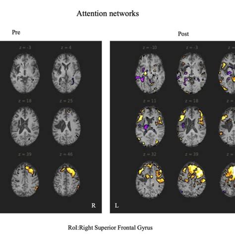 FIGURE The right superior temporal gyrus was set as the region of ...