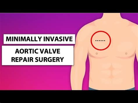 Surgeon Q A Minimally Invasive Aortic Valve Repair With Dr Hiroo