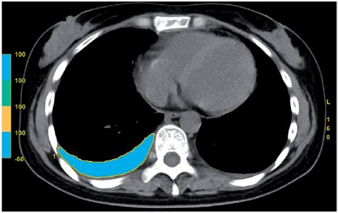 The Measurement Of Pleural Effusion Volume With Chest Ct Images Download Scientific Diagram