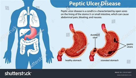 Peptic Ulcer Disease Infographic Illustration Royalty Free Stock