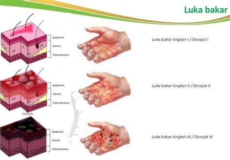 Luka Bakar Dan Pertolongan Pertamanya Rs Kasih Ibu Surakarta