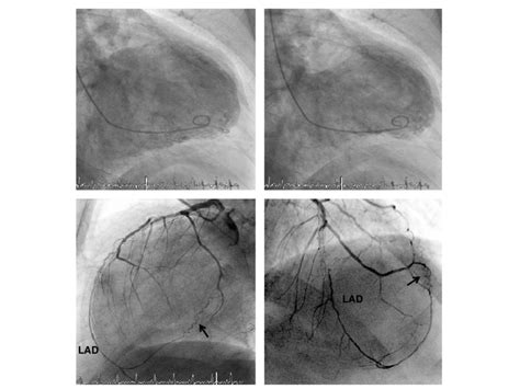 Left Ventricular Angiogram Upper Panels With Extensive Antero Apical