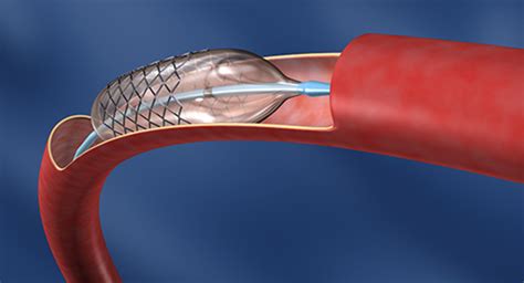 ¿qué Es Y Cómo Se Realiza Una Angioplastia Dr Roberto Larghi