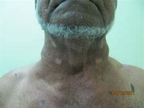 Figure 1 From Axillary Lymph Node Metastasis From Thyroid Malignancy