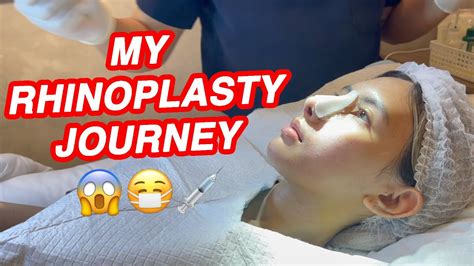 RHINOPLASTY JOURNEY YouTube