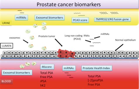 An Overview On Prostate Pathophysiology New Insights Into Prostate Cancer Clinical Diagnosis