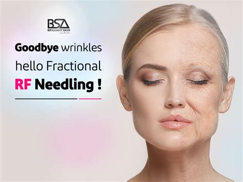 Fractional Rf Needling Unlocking Radiant Skin