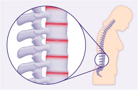 Bandscheibenvorfall Der Halswirbels Ule Hws Symptome Diagnose Und