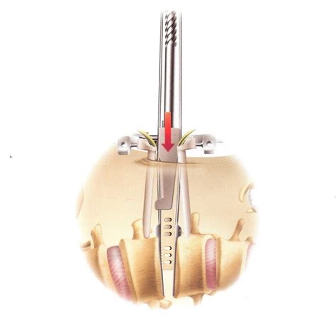 Extreme Lateral Minimally Invasive Fusion Xlif Spinecare Medical Group