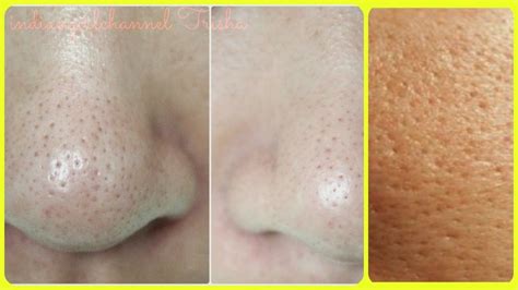 Get Rid Of Large Pores 4 Best Remedy Get Smooth Tighter Younger