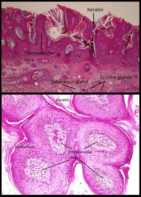 Acrochordon Histology