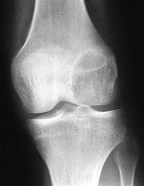 Chondroblastoma Gross