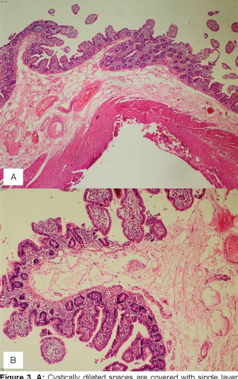 Figure 1 From Ileoileal Intussusception Caused By Ileal Lymphangioma In An Adult A Rare Case