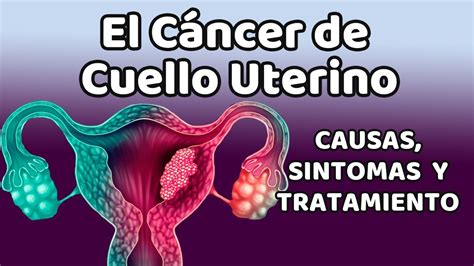 Todo Lo Que Necesitas Saber Sobre El Cáncer De Cuello Uterino Causas