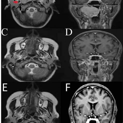 A: T2 axial MRI showing an expansive lesion in the right parapharyngeal... | Download Scientific ...