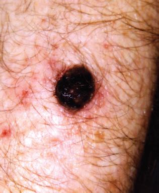 Nodular Melanoma Definition Symptoms Pictures More 40 OFF