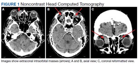 Orbital Varix Masquerading As An Intraorbital Lymphoma Mdedge