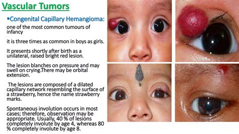 Benign Eyelid Tumors Ppt