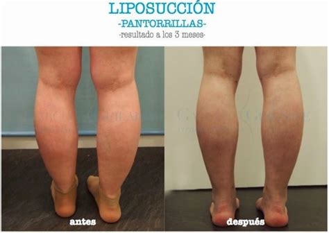 Liposucción de piernas pantorrillas y o gemelos