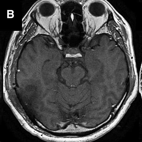 Postoperative Mri Showing Total Resection Of The Tumor A Dwi B