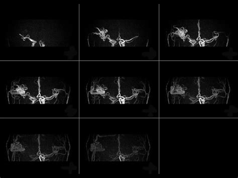 Contrast Free Imaging Of Brain Vascular Anatomy Philips Mr Body Map