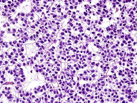 Benign And Malignant Neoplasms Of The Testis And Paratesticular Tissue