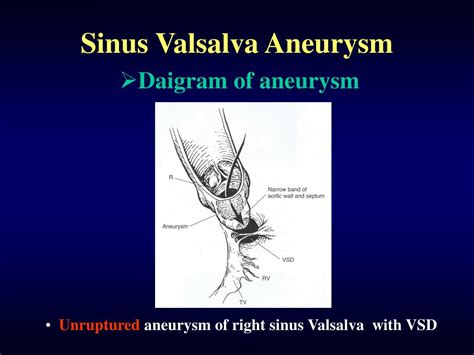 Ppt Sinus Valsalva Aneurysm Powerpoint Presentation Free Download