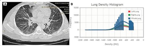 Female Patient 42 Years Old Fev1 72 A Axial Hrct Image Shows Ggo Download Scientific Diagram