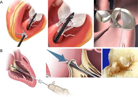 Pdf Transapical Beating Heart Chordae Implantation In Mitral