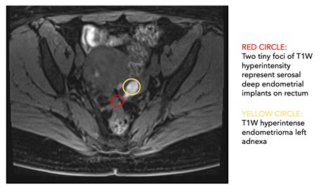 Endometriosis: Getting answers with MRI