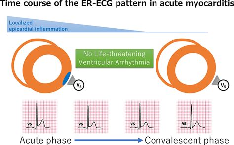 Myocarditis Ecg Changes