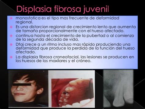 Displasia fibrosa