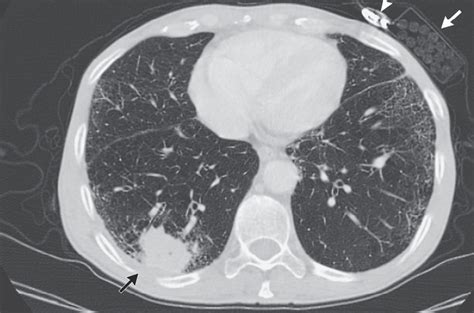 Figure Squamous Cell Carcinoma Of The Statpearls Ncbi Bookshelf