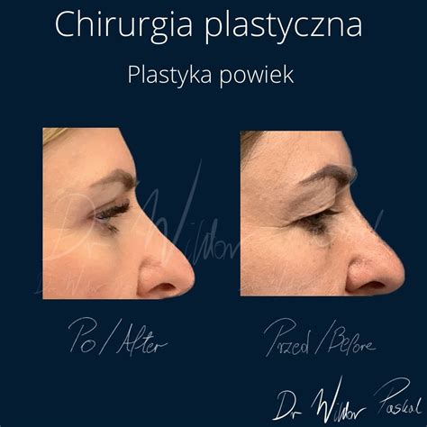 Korekta Nosa Kwasem Hialuronowym Przed I Po Estheticon Pl Estheticon Pl