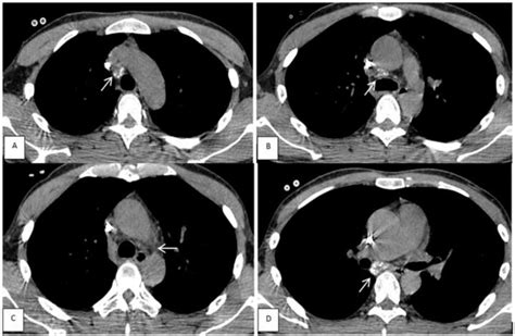 Figure From Primary Mediastinal Lymph Node Tuberculosis Diagnosed