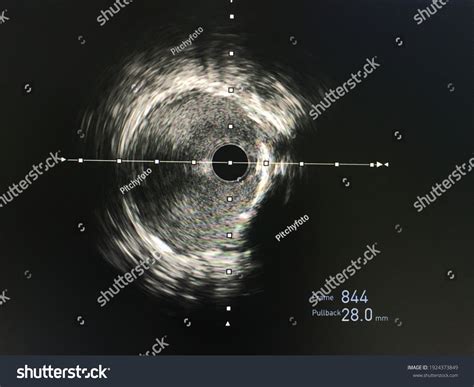 intravascular ultrasound interventional cardiology   images