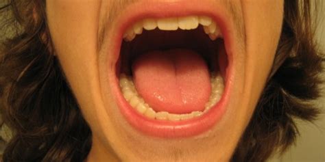 White spots in mouth | Ear, Nose, Throat, and Dental problems articles ...