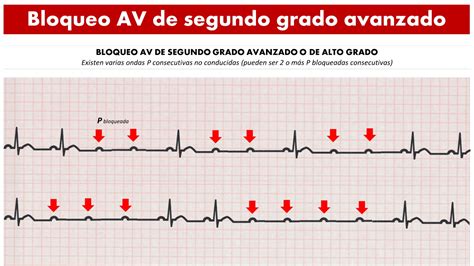 CardioTruco Bloqueos AV Cardioprimaria Ferrol