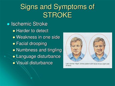 Ppt Stroke Powerpoint Presentation Free Download Id 5390877