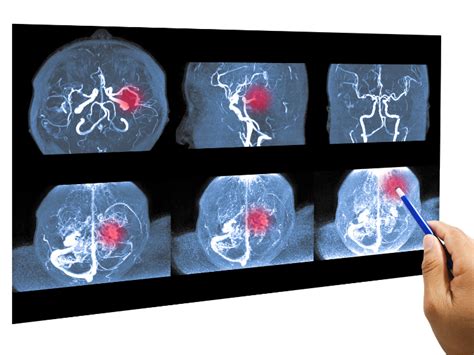 Aneurisma Cerebral O Que Cauras E Sintomas Dr Tobias Ludwig