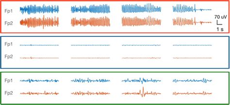 Induced seizure (upper panel) and immediate postictal state (middle... | Download Scientific Diagram