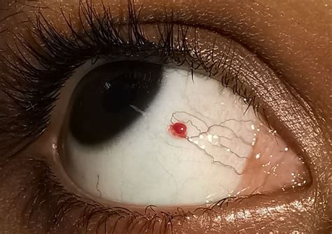 Acquired Sessile Conjunctival Capillary Haemangioma In An Adult Managed