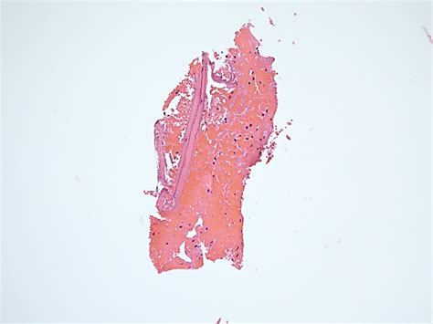 Clinical Pathologic Conference Case A Multilocular Radiolucency Of