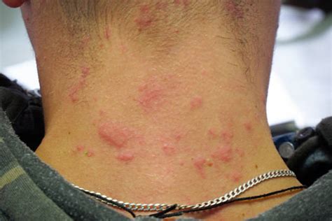 Stress Rash On Neck