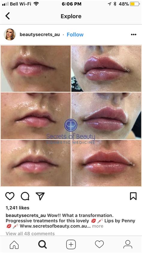 Lipfillersbeforeandafter Lip Fillers Lip Injections Lip Augmentation