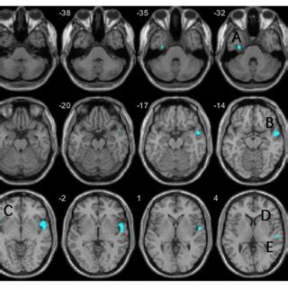 Regions Showing Reduced Gray Matter Volume In The VSZ And NvSZ Groups