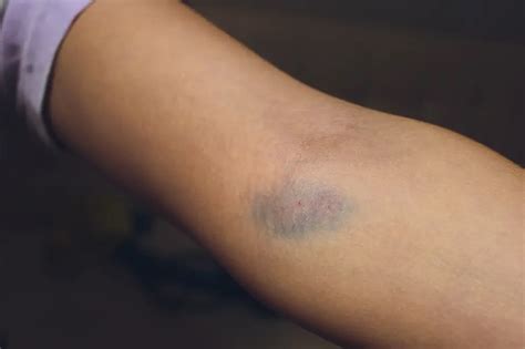 Hematoma Formation Post Phlebotomy Causes Symptoms And Treatment