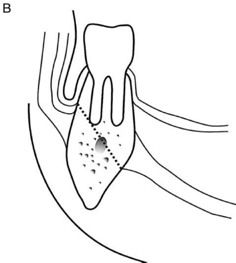 135 Surgical Resection Of Cancer Of The Buccal Mucosa Medicine