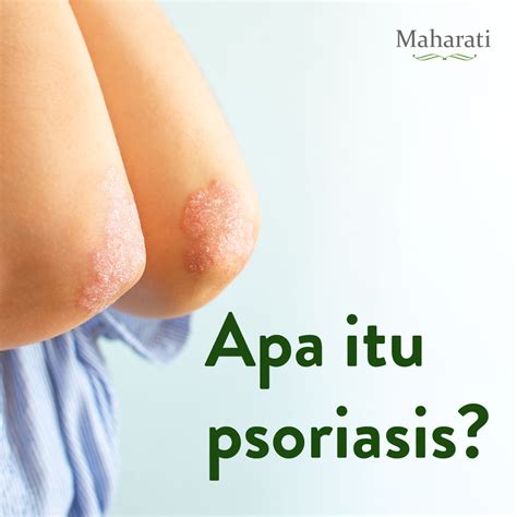 Kenali Penyakit Kulit Psoriasis - Maharati