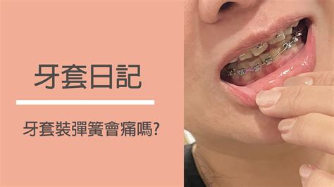 牙套日記2│ 裝彈簧會痛嗎？矯正牙齒很痛怎麼辦？ 呂萱萱愛分享